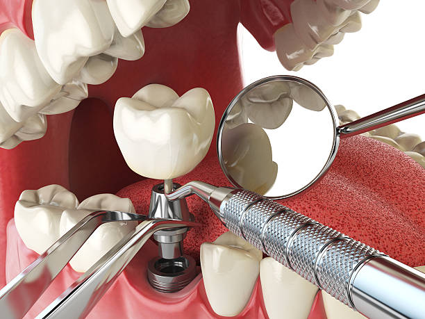 Best Emergency Wisdom Teeth Removal in Vivian, LA